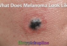 What Does Melanoma Look Like What Does Melanoma Look Like